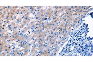 Immunohistochemistry of paraffin-embedded Human liver cancer tissue using LAMA3 Polyclonal Antibody at dilution 1:30