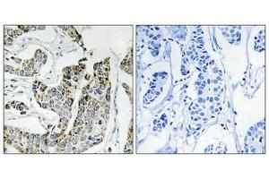 Immunohistochemical analysis of paraffin-embedded human breast carcinoma tissue using BLK (Phospho-Tyr501) antibody (left)or the same antibody preincubated with blocking peptide (right). (BLK antibody  (pTyr501))