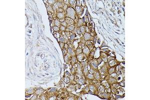 Immunohistochemistry of paraffin-embedded human breast cancer using β-Catenin antibody (ABIN7266137) at dilution of 1:100 (40x lens). (CTNNB1 antibody)