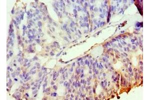 Immunohistochemistry of paraffin-embedded human endometrial cancer using ABIN7169127 at dilution of 1:100 (PAK2 antibody  (AA 1-212))