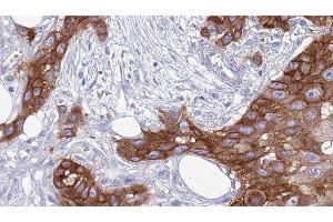 ABIN6277559 at 1/100 staining Human Head and neck cancer tissue by IHC-P.