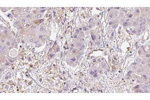 ABIN6273950 at 1/100 staining Human liver cancer tissue by IHC-P. (MRGPRD antibody  (C-Term))