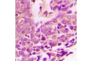 Immunohistochemical analysis of XIAP staining in human breast cancer formalin fixed paraffin embedded tissue section. (XIAP antibody  (Center))