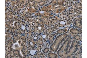 The image on the left is immunohistochemistry of paraffin-embedded Human thyroid cancer tissue using ABIN7129587(GDF3 Antibody) at dilution 1/25, on the right is treated with fusion protein. (GDF3 antibody)