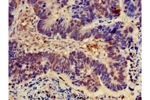 Immunohistochemistry of paraffin-embedded human ovarian cancer using ABIN7162073 at dilution of 1:100