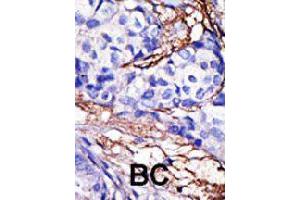 Formalin-fixed and paraffin-embedded human cancer tissue reacted with RBCK1 polyclonal antibody  , which was peroxidase-conjugated to the secondary antibody, followed by DAB staining. (RBCK1 antibody  (N-Term))