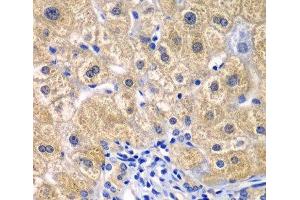 Immunohistochemistry of paraffin-embedded Human liver damage using CARD11 Polyclonal Antibody at dilution of 1:100 (40x lens).