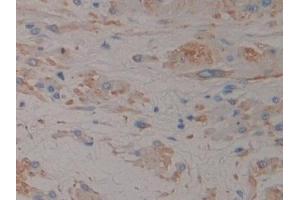 Detection of NT-ProANP in Human Prostate Tissue using Polyclonal Antibody to N-Terminal Pro-Atrial Natriuretic Peptide (NT-ProANP)