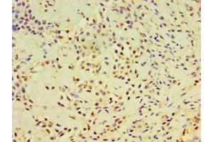 Immunohistochemistry of paraffin-embedded human breast cancer using ABIN7164384 at dilution of 1:100 (DHX58 antibody  (AA 389-678))