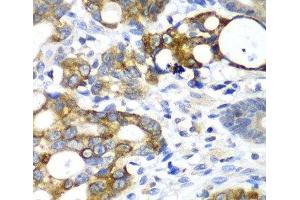 Immunohistochemistry of paraffin-embedded Human gastric cancer using AMY2A Polyclonal Antibody at dilution of 1:100 (40x lens). (AMY2A antibody)