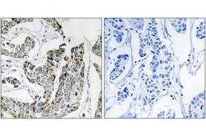 Immunohistochemistry analysis of paraffin-embedded human breast carcinoma, using BLK (Phospho-Tyr501) Antibody.