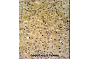 NDUFA10 Antibody (Center) (ABIN653725 and ABIN2843032) IHC analysis in formalin fixed and paraffin embedded hepatocarcinoma followed by peroxidase conjugation of the secondary antibody and DAB staining. (NDUFA10 antibody  (AA 252-281))