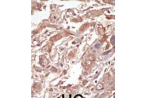 Formalin-fixed and paraffin-embedded human cancer tissue reacted with the primary antibody, which was peroxidase-conjugated to the secondary antibody, followed by DAB staining. (STK10-A antibody  (C-Term))