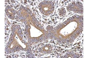 IHC-P Image Immunohistochemical analysis of paraffin-embedded human colon carcinoma, using SERCA3, antibody at 1:500 dilution.