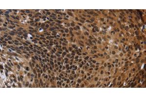 Immunohistochemistry of paraffin-embedded Human cervical cancer using FHL3 Polyclonal Antibody at dilution of 1:40 (FHL3 antibody)