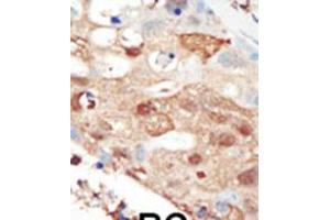 Formalin-fixed and paraffin-embedded human cancer tissue reacted with the primary antibody, which was peroxidase-conjugated to the secondary antibody, followed by AEC staining. (PIK3R2 antibody  (C-Term))