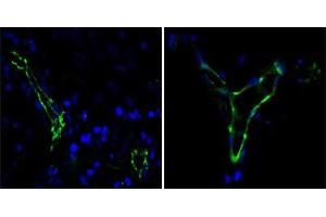 Immunofluorescence analysis of paraffin-embedded human lung cancer(left) and breast cancer(right) cells using CD31 mouse mAb (green).