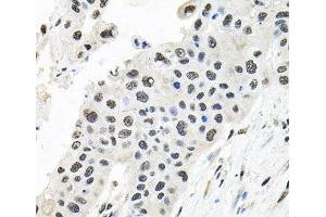 Immunohistochemistry of paraffin-embedded Human lung cancer using CDCA8 Polyclonal Antibody at dilution of 1:100 (40x lens). (CDCA8 antibody)