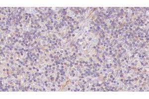 ABIN6273117 at 1/100 staining Human lymph cancer tissue by IHC-P. (FECH antibody  (C-Term))
