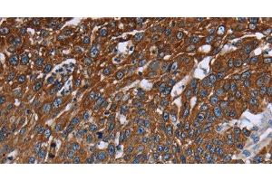 Immunohistochemistry of paraffin-embedded Human lung cancer tissue using FCGR3A Polyclonal Antibody at dilution 1:40 (FCGR3A antibody)