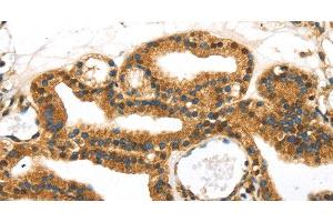 Immunohistochemistry of paraffin-embedded Human thyroid cancer tissue using SERPINB8 Polyclonal Antibody at dilution 1:40 (SERPINB8 antibody)