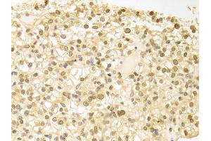 Immunohistochemistry of paraffin-embedded human kidney cancer using PLCB1 antibody. (Phospholipase C beta 1 antibody)