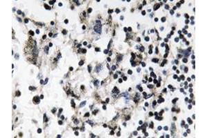 Immunohistochemistry analyzes of Catenin-β antibody in paraffin-embedded human breast carcinoma tissue. (CDC37 antibody)