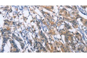 Immunohistochemistry of paraffin-embedded Human colon cancer using SYT17 Polyclonal Antibody at dilution of 1:60 (SYT17 antibody)