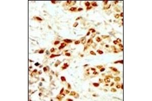 Formalin-fixed and paraffin-embedded human cancer tissue reacted with the primary antibody, which was peroxidase-conjugated to the secondary antibody, followed by DAB staining. (DAPK2 antibody  (N-Term))