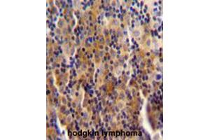 SYNE3 antibody (C-term) immunohistochemistry analysis in formalin fixed and paraffin embedded human hodgkin lymphoma followed by peroxidase conjugation of the secondary antibody and DAB staining.