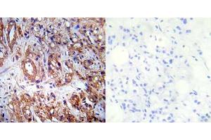 Immunohistochemical analysis of paraffin-embedded human prostate carcinoma tissue using Tsc2 (phospho-Ser939) antibody (E012049). (Tuberin antibody  (pSer939))