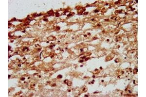 IHC image of ABIN7161596 diluted at 1:200 and staining in paraffin-embedded human melanoma performed on a Leica BondTM system. (Nidogen 1 antibody  (AA 792-942))
