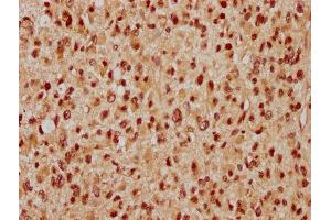 IHC image of ABIN7175822 diluted at 1:300 and staining in paraffin-embedded human glioma performed on a Leica BondTM system. (WAPAL antibody  (AA 1037-1190))