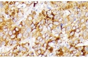 Immunohistochemistry of paraffin-embedded Human liver cancer using GALC Polyclonal Antibody at dilution of 1:100 (40x lens). (GALC antibody)