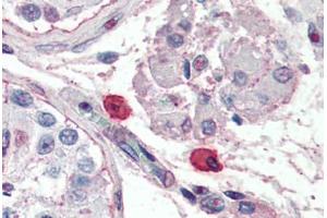 Human Mast Cells (formalin-fixed, paraffin-embedded) stained with Fc Epsilon Receptor 1 (FceR1) antibody ABIN396944 at 10 ug/ml followed by biotinylated anti-mouse IgG secondary antibody ABIN481714, alkaline phosphatase-streptavidin and chromogen. (Fc epsilon Receptor 1 antibody)