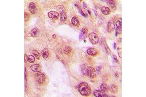 Immunohistochemical analysis of PSMC5 staining in human lung cancer formalin fixed paraffin embedded tissue section. (PSMC5 antibody)