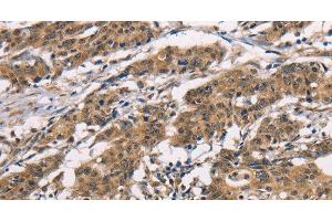 Immunohistochemistry of paraffin-embedded Human gasrtic cancer tissue using ADGRB1 Polyclonal Antibody at dilution 1:40 (ADGRB1 antibody)