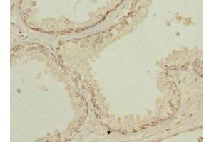 Immunohistochemistry of paraffin-embedded human prostate cancer using ABIN7154259 at dilution of 1:100 (NMT2 antibody  (AA 1-120))