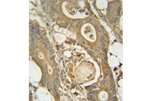Immunohistochemistry analysis in formalin fixed and paraffin embedded human colon carcinoma reacted with GCNT3 Antibody (C-term) followed by peroxidase conjugation of the secondary antibody and DAB staining.
