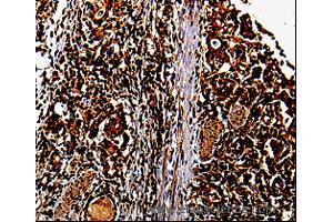 Immunohistochemistry of Human stomach cancer using MMP13 Polyclonal Antibody at dilution of 1:10 (MMP13 antibody)