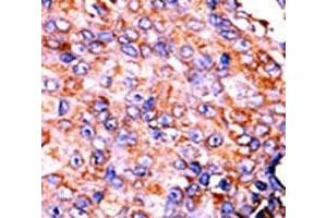 IHC analysis of FFPE human breast carcinoma tissue stained with the p-STAT3 antibody. (STAT3 antibody  (pSer727))