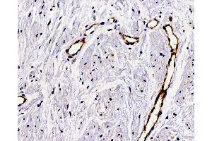 Immunohistochemistry analysis of paraffin-embedded Human hysteromyoma using VWF Polyclonal Antibody at dilution of 1:300. (VWF antibody)