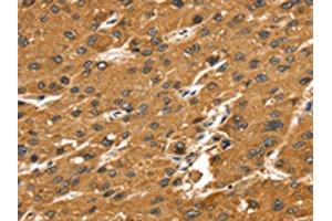 The image on the left is immunohistochemistry of paraffin-embedded Human liver cancer tissue using ABIN7192644(SRGAP1 Antibody) at dilution 1/25, on the right is treated with synthetic peptide. (SRGAP1 antibody)