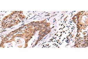 Immunohistochemistry of paraffin-embedded Human esophagus cancer tissue using KATNAL1 Polyclonal Antibody at dilution of 1:95(x200) (KATNAL1 antibody)