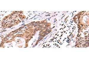 Immunohistochemistry of paraffin-embedded Human esophagus cancer tissue using KATNAL1 Polyclonal Antibody at dilution of 1:95(x200)