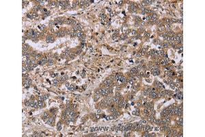 Immunohistochemistry of Human liver cancer using FHL1 Polyclonal Antibody at dilution of 1:20 (FHL1 antibody)