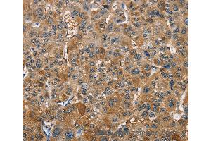 Immunohistochemistry of Human gastric cancer using TRIP4 Polyclonal Antibody at dilution of 1:40 (TRIP4 antibody)