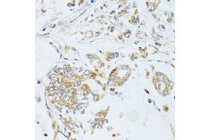Immunohistochemistry of paraffin-embedded human gastric cancer using MAD2L2 antibody. (MAD2L2 antibody  (AA 1-211))