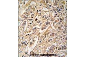 Formalin-fixed and paraffin-embedded human breast carcinoma tissue reacted with 14-3-3 protein zeta/delta antibody (C-term) (ABIN392782 and ABIN2842219) , which was peroxidase-conjugated to the secondary antibody, followed by DAB staining. (14-3-3 zeta antibody  (AA 216-245))