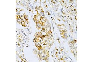Immunohistochemistry of paraffin-embedded human gastric cancer using OLR1 Antibody (ABIN5970808) at dilution of 1/200 (40x lens). (OLR1 antibody)